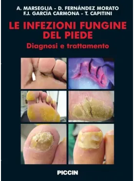 Le Infezioni Fungine del Piede