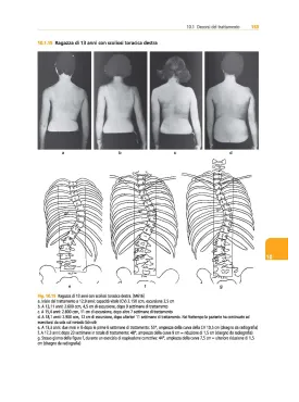 Trattamento tridimensionale della scoliosi