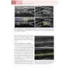 Elettromiografia e Disordini neuromuscolari: Correlazioni clinico-elettrofisiologiche ed ecografiche