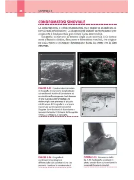 Ecografia muscoloscheletrica delle tumefazioni delle parti molli