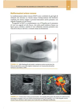 Ecografia muscoloscheletrica delle tumefazioni delle parti molli