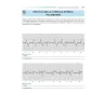 ECG WORKOUT - ESERCIZI DI INTERPRETAZIONE delle ARITMIE CARDIACHE