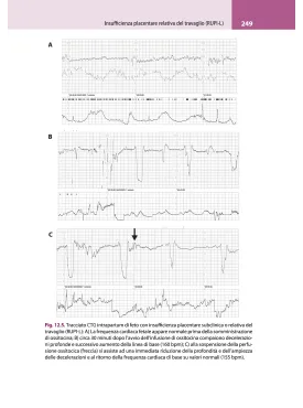 La lettura fisiopatologica della cardiotocografia intrapartum