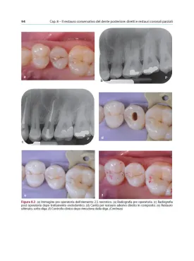 IL RESTAURO DEL DENTE TRATTATO ENDODONTICAMENTE