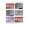 IL RESTAURO DEL DENTE TRATTATO ENDODONTICAMENTE