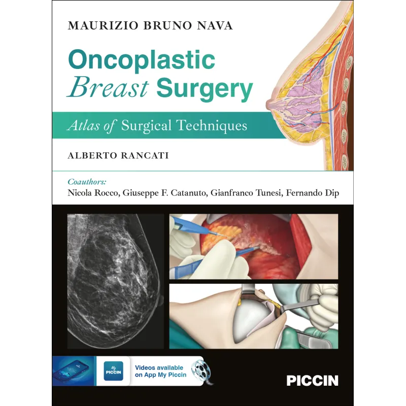 Oncoplastic Breast Surgery. Atlas of Surgical Techniques