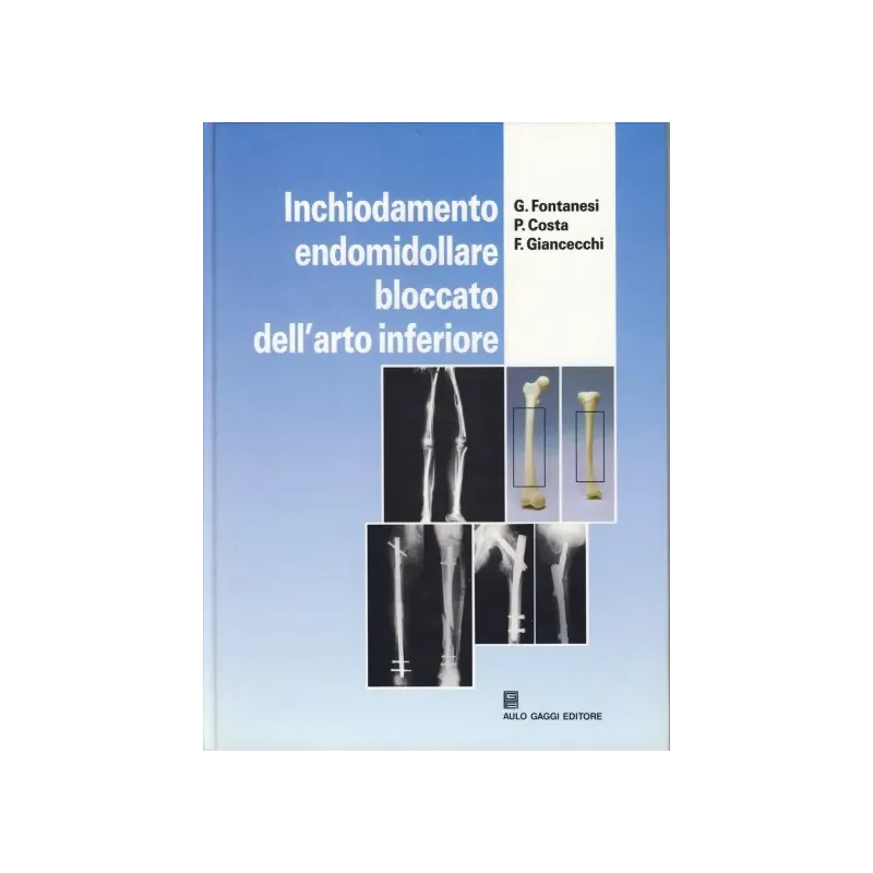 Inchiodamento endomidollare bloccato dell'arto inferiore